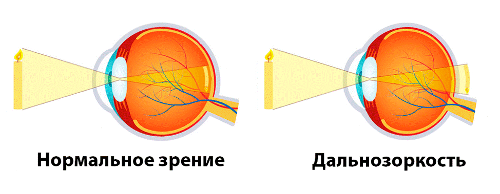 Гиперметропия или Дальнозоркость