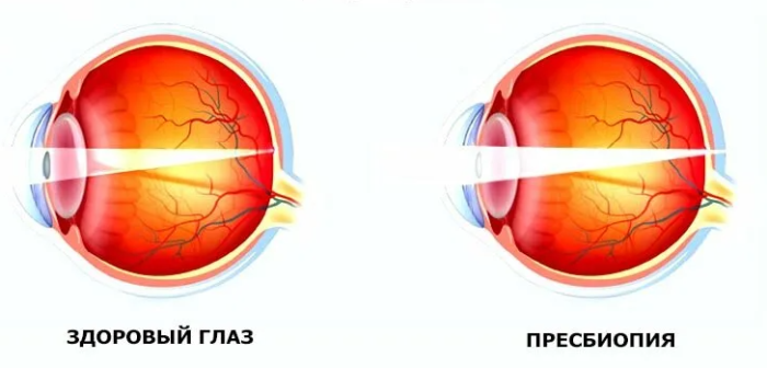 Пресбиопия